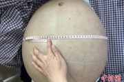 中新健康丨男子“腹大如鼓” 江西省人民医院团队为其切除病肝568斤
